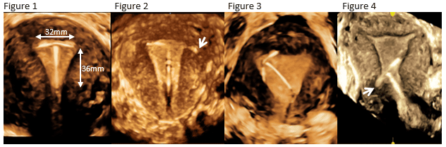 paragard iud ultrasound